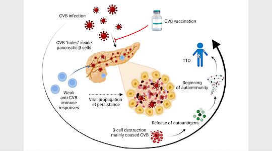 Étapes conduisant au diabète après infection par le Coxsackievirus B