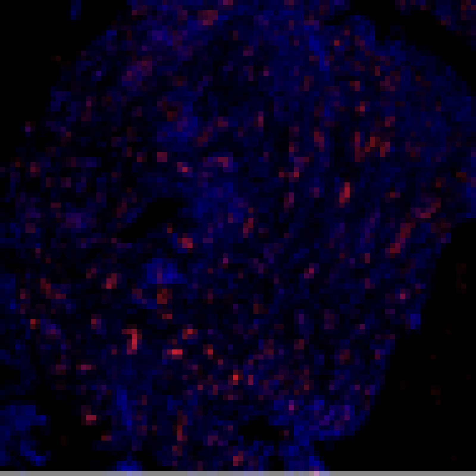 Image de vaisseaux sanguins (coloration rouge) au sein d’une coupe de tissu synovial d’un patient atteint de polyarthrite rhumatoïde