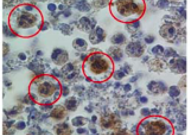 image microscopie détection PCNA dans neutrophiles projet Contrôle de l’activation et de la mort des neutrophiles dans la mucoviscidose équipe Witko