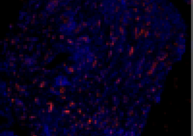 Image de vaisseaux sanguins (coloration rouge) au sein d’une coupe de tissu synovial d’un patient atteint de polyarthrite rhumatoïde